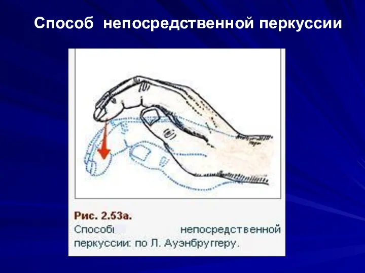 Способ непосредственной перкуссии