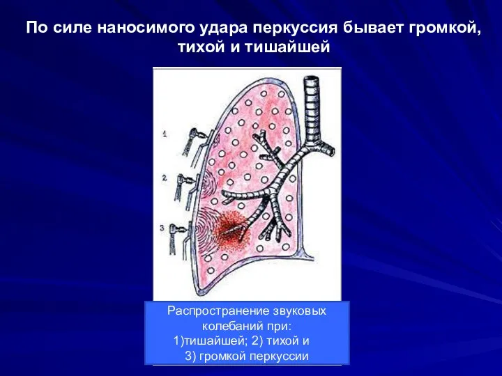 По силе наносимого удара перкуссия бывает громкой, тихой и тишайшей Распространение