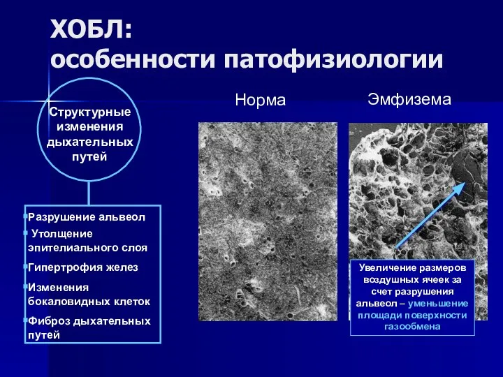 ХОБЛ: особенности патофизиологии Структурные изменения дыхательных путей Разрушение альвеол Утолщение эпителиального