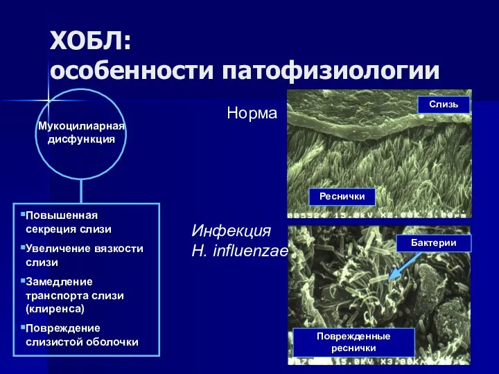 ХОБЛ: особенности патофизиологии Мукоцилиарная дисфункция Повышенная секреция слизи Увеличение вязкости слизи