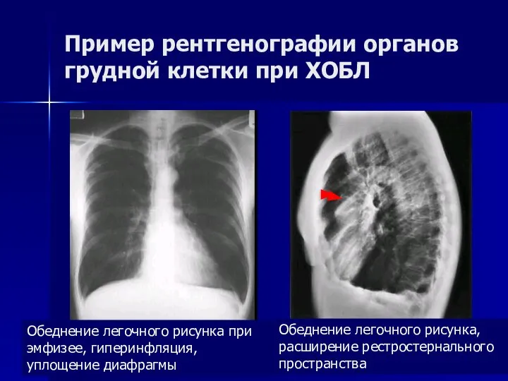 Пример рентгенографии органов грудной клетки при ХОБЛ Обеднение легочного рисунка при