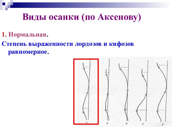 Виды осанки (по Аксенову) 1. Нормальная. Степень выраженности лордозов и кифозов равномерное.