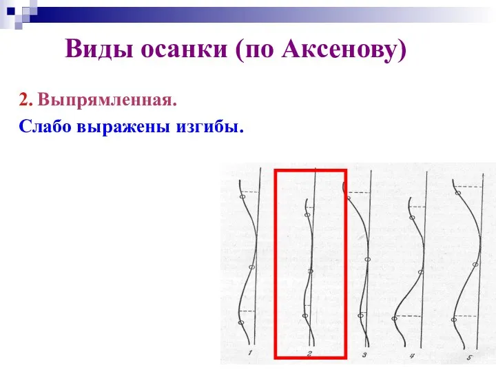 Виды осанки (по Аксенову) 2. Выпрямленная. Слабо выражены изгибы.