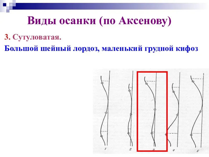 Виды осанки (по Аксенову) 3. Сутуловатая. Большой шейный лордоз, маленький грудной кифоз