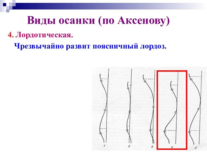 Виды осанки (по Аксенову) 4. Лордотическая. Чрезвычайно развит поясничный лордоз.