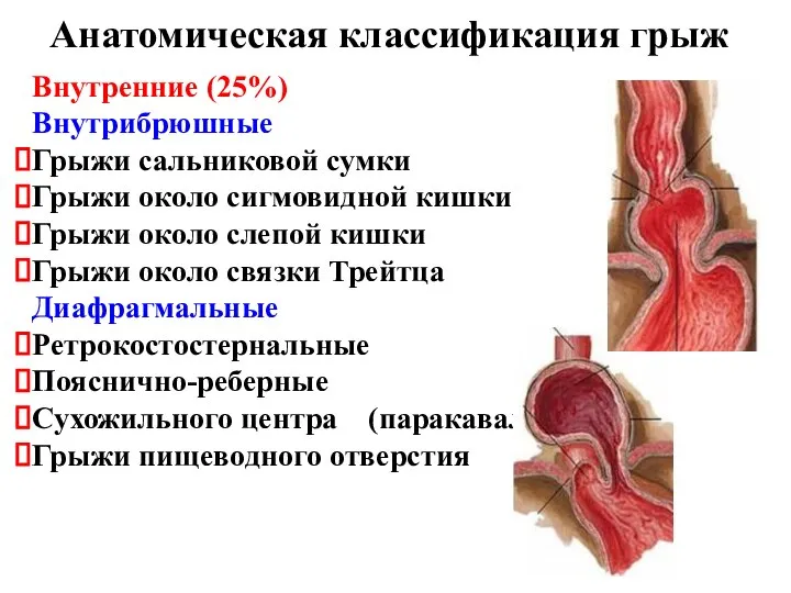 Внутренние (25%) Внутрибрюшные Грыжи сальниковой сумки Грыжи около сигмовидной кишки Грыжи