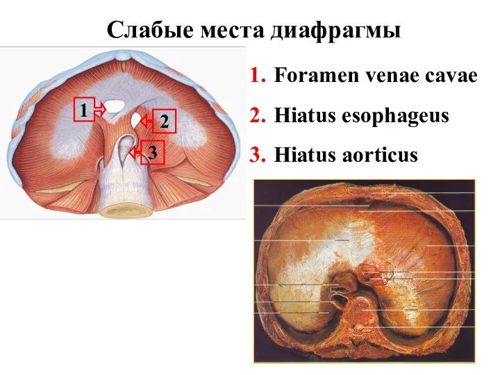 Слабые места диафрагмы 2 1 Foramen venae cavae Hiatus esophageus Hiatus aorticus 3