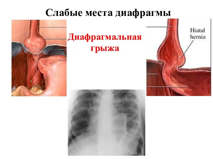 Слабые места диафрагмы Диафрагмальная грыжа