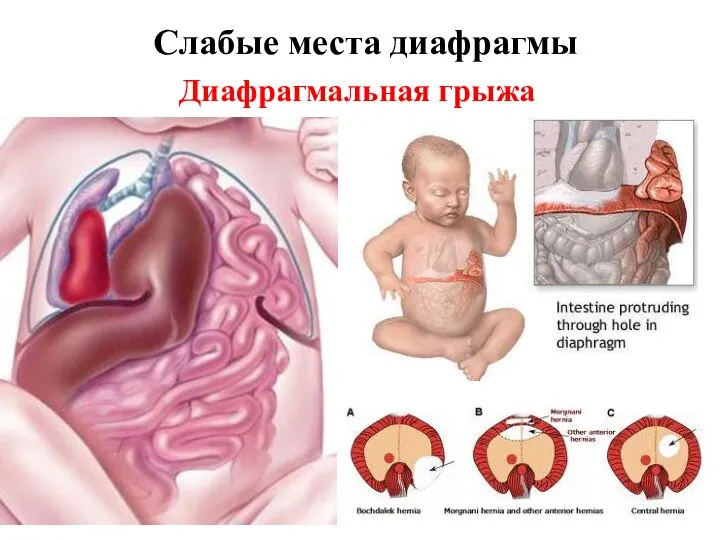 Слабые места диафрагмы Диафрагмальная грыжа