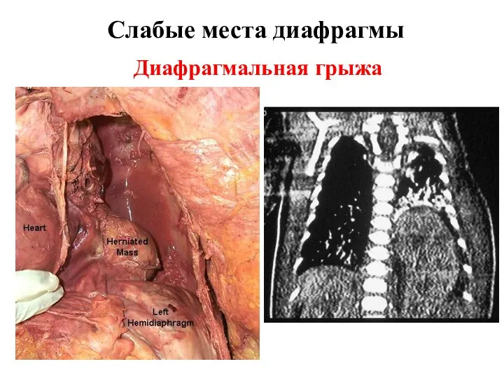 Слабые места диафрагмы Диафрагмальная грыжа