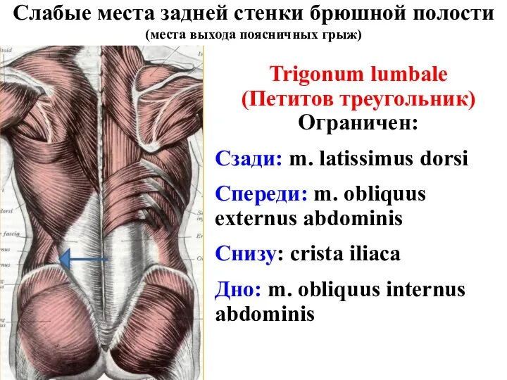 Слабые места задней стенки брюшной полости (места выхода поясничных грыж) Trigonum