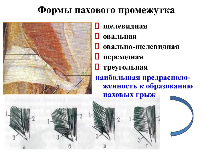 Формы пахового промежутка щелевидная овальная овально-щелевидная переходная треугольная наибольшая предрасполо-женность к образованию паховых грыж