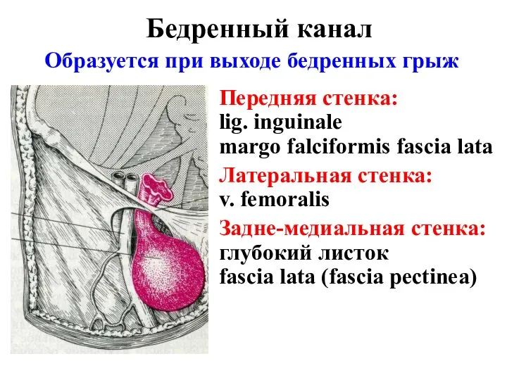 Бедренный канал Образуется при выходе бедренных грыж Передняя стенка: lig. inguinale