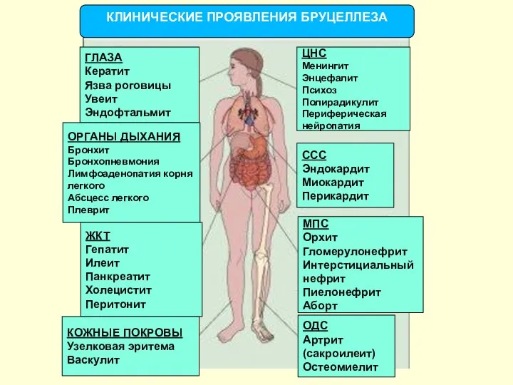 КЛИНИЧЕСКИЕ ПРОЯВЛЕНИЯ БРУЦЕЛЛЕЗА ГЛАЗА Кератит Язва роговицы Увеит Эндофтальмит ОРГАНЫ ДЫХАНИЯ