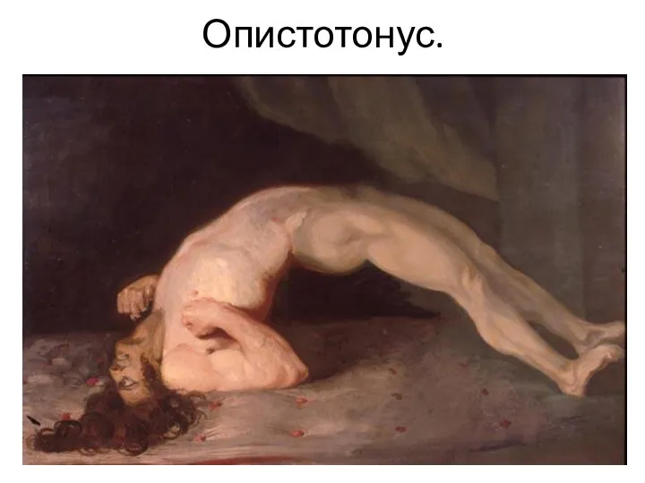 Опистотонус.