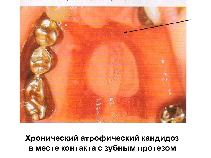 Хронический атрофический кандидоз в месте контакта с зубным протезом