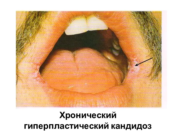 Хронический гиперпластический кандидоз углов рта