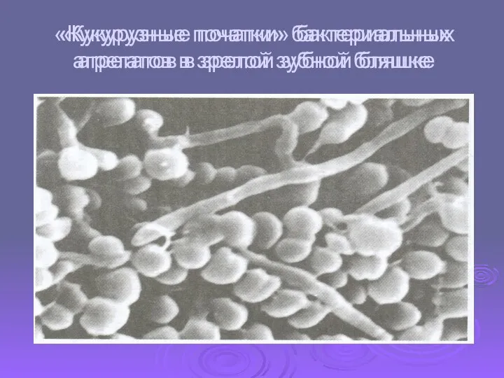 «Кукурузные початки» бактериальных агрегатов в зрелой зубной бляшке «Кукурузные початки» бактериальных агрегатов в зрелой зубной бляшке