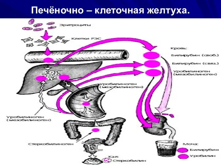 Печёночно – клеточная желтуха.