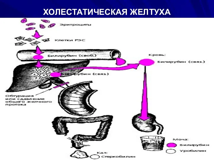 ХОЛЕСТАТИЧЕСКАЯ ЖЕЛТУХА