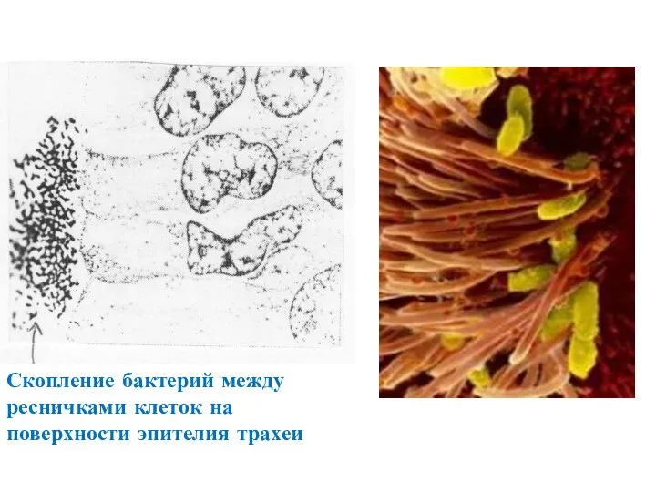 Скопление бактерий между ресничками клеток на поверхности эпителия трахеи