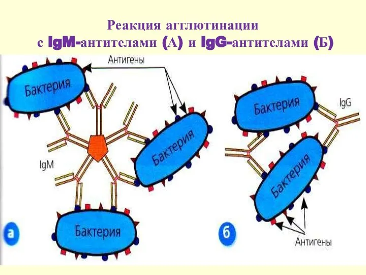 Реакция агглютинации с lgM-антителами (А) и lgG-антителами (Б)