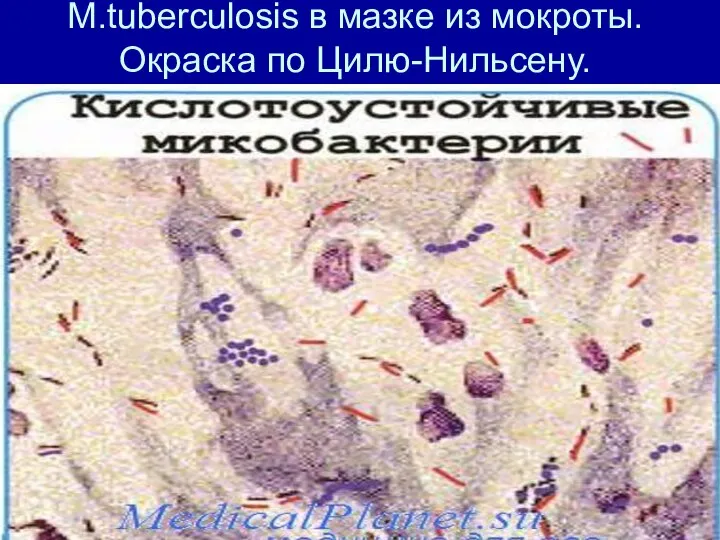 M.tuberculosis в мазке из мокроты. Окраска по Цилю-Нильсену.