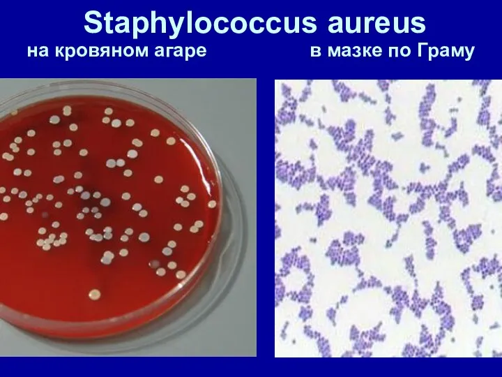 Staphylococcus aureus на кровяном агаре в мазке по Граму