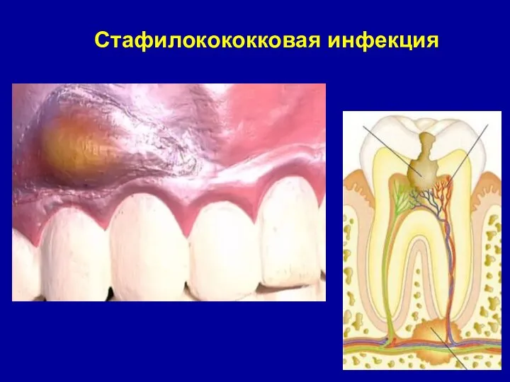 Стафилокококковая инфекция