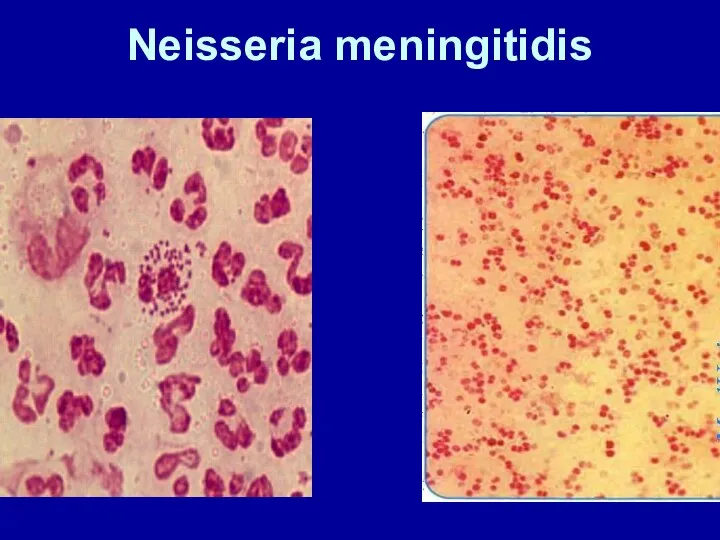 Neisseria meningitidis