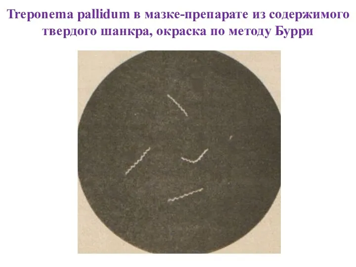 Treponema pallidum в мазке-препарате из содержимого твердого шанкра, окраска по методу Бурри