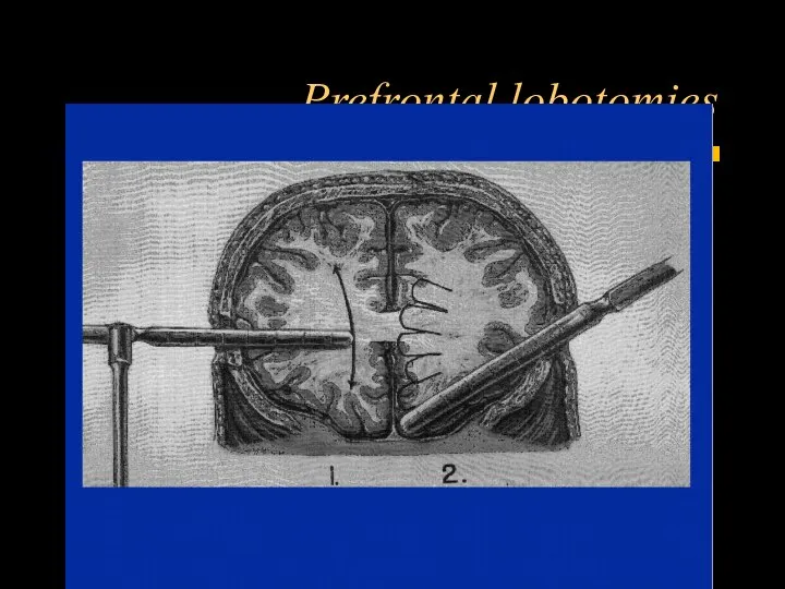 Prefrontal lobotomies