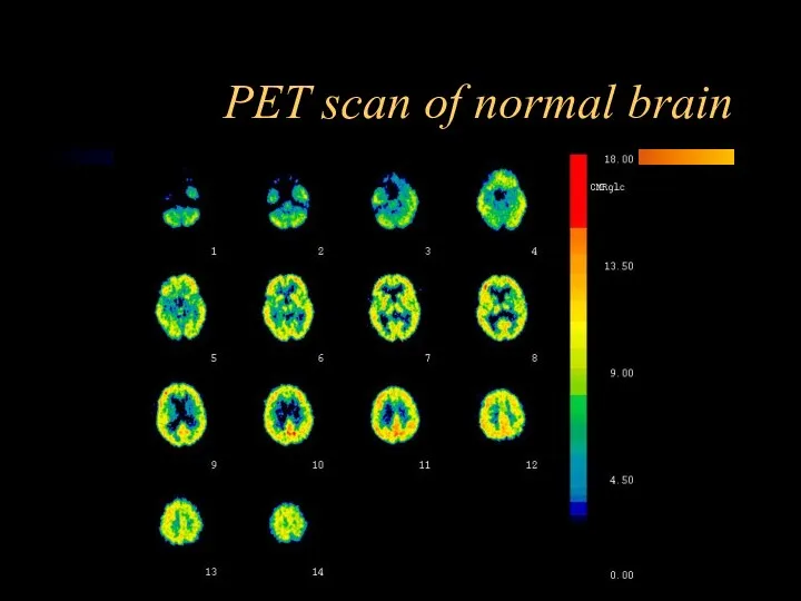 PET scan of normal brain