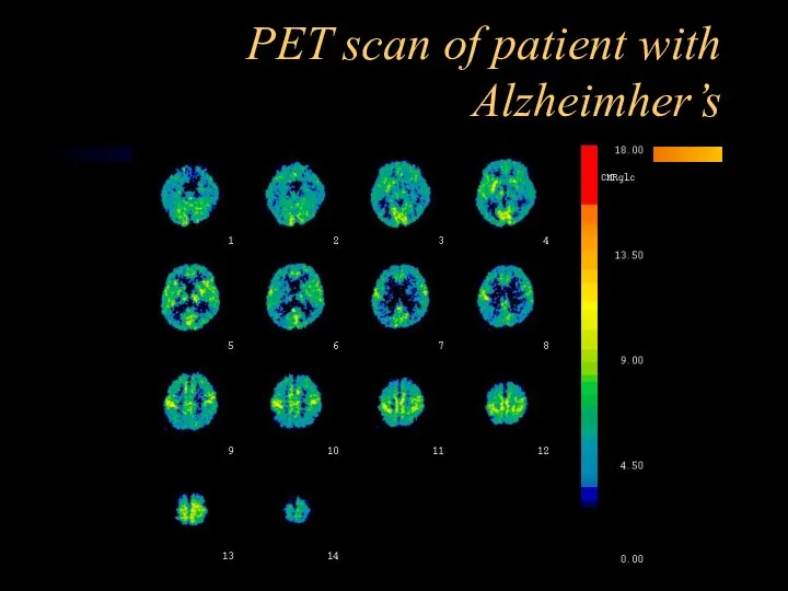 PET scan of patient with Alzheimher’s