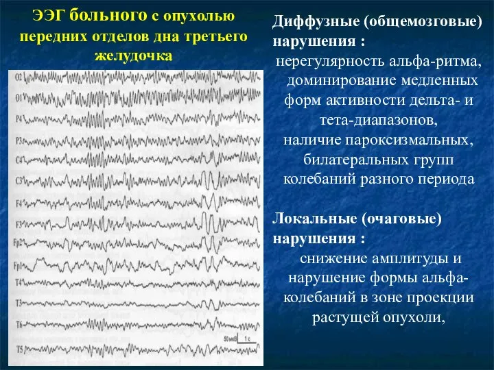 ЭЭГ больного с опухолью передних отделов дна третьего желудочка Диффузные (общемозговые)