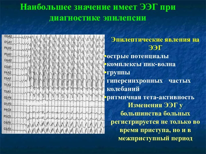 Наибольшее значение имеет ЭЭГ при диагностике эпилепсии Эпилептические явления на ЭЭГ