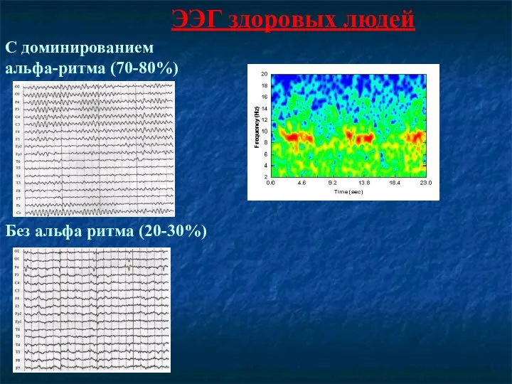 ЭЭГ здоровых людей С доминированием альфа-ритма (70-80%) Без альфа ритма (20-30%)