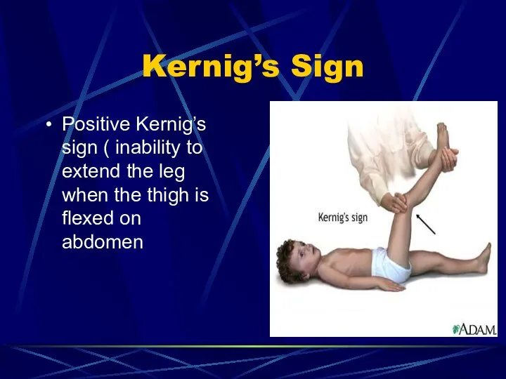 Kernig’s Sign Positive Kernig’s sign ( inability to extend the leg