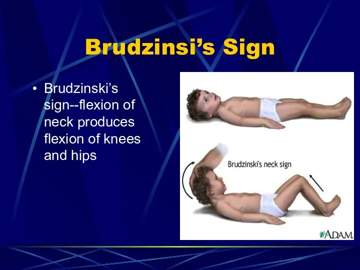 Brudzinsi’s Sign Brudzinski’s sign--flexion of neck produces flexion of knees and hips