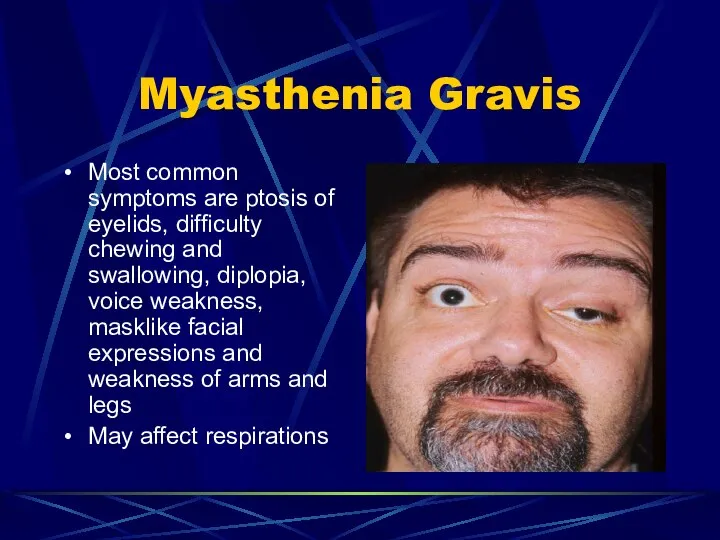 Myasthenia Gravis Most common symptoms are ptosis of eyelids, difficulty chewing
