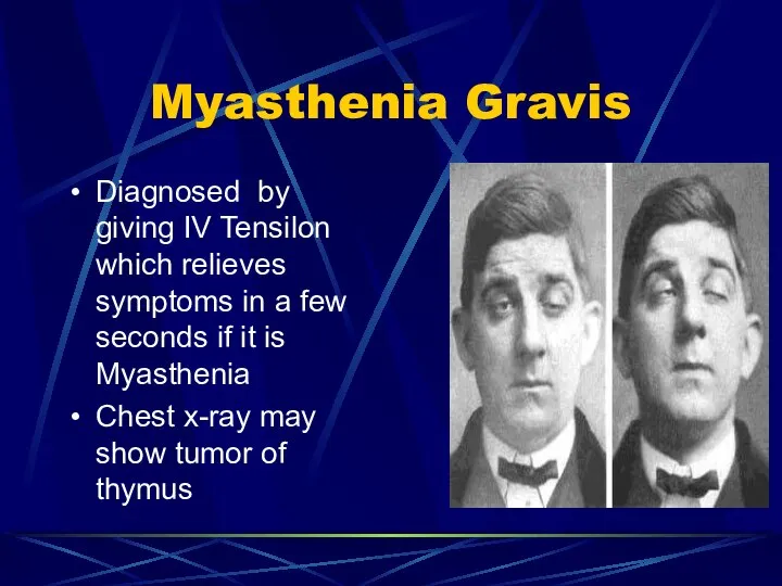 Myasthenia Gravis Diagnosed by giving IV Tensilon which relieves symptoms in