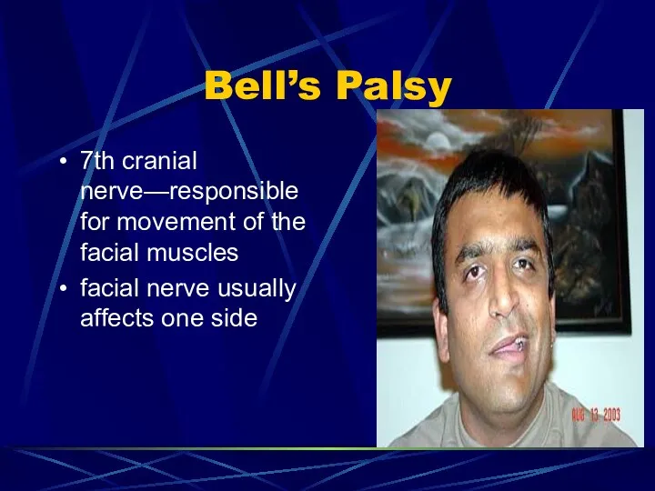 Bell’s Palsy 7th cranial nerve—responsible for movement of the facial muscles