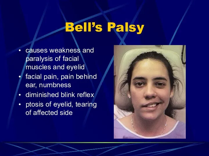 Bell’s Palsy causes weakness and paralysis of facial muscles and eyelid