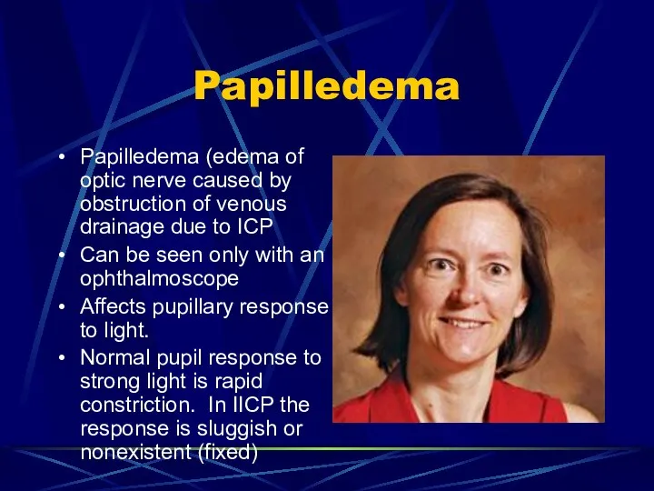 Papilledema Papilledema (edema of optic nerve caused by obstruction of venous