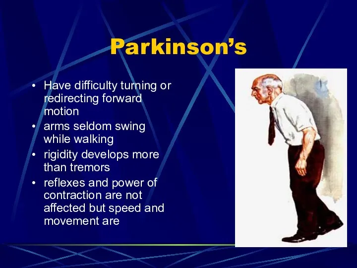 Parkinson’s Have difficulty turning or redirecting forward motion arms seldom swing