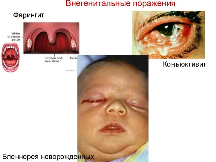 Фарингит Фарингит Бленнорея новорожденных Конъюктивит Внегенитальные поражения