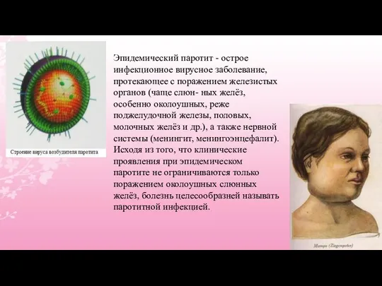 Эпидемический паротит - острое инфекционное вирусное заболевание, протекающее с поражением железистых