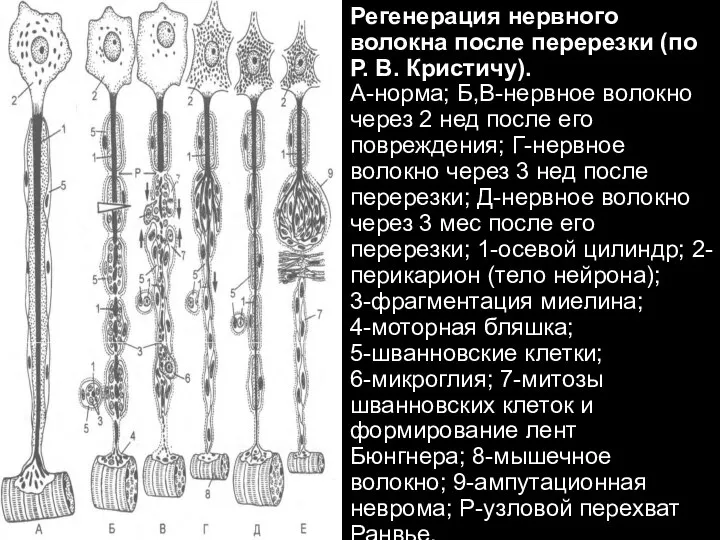 Регенерация нервного волокна после перерезки (по Р. В. Кристичу). А-норма; Б,В-нервное