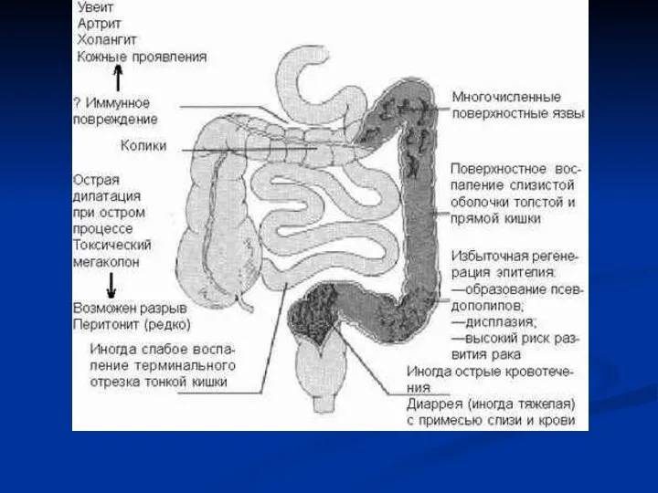 Осложнения язвенного колита