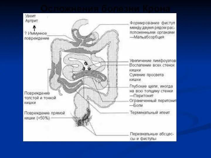 Осложнения болезни Крона